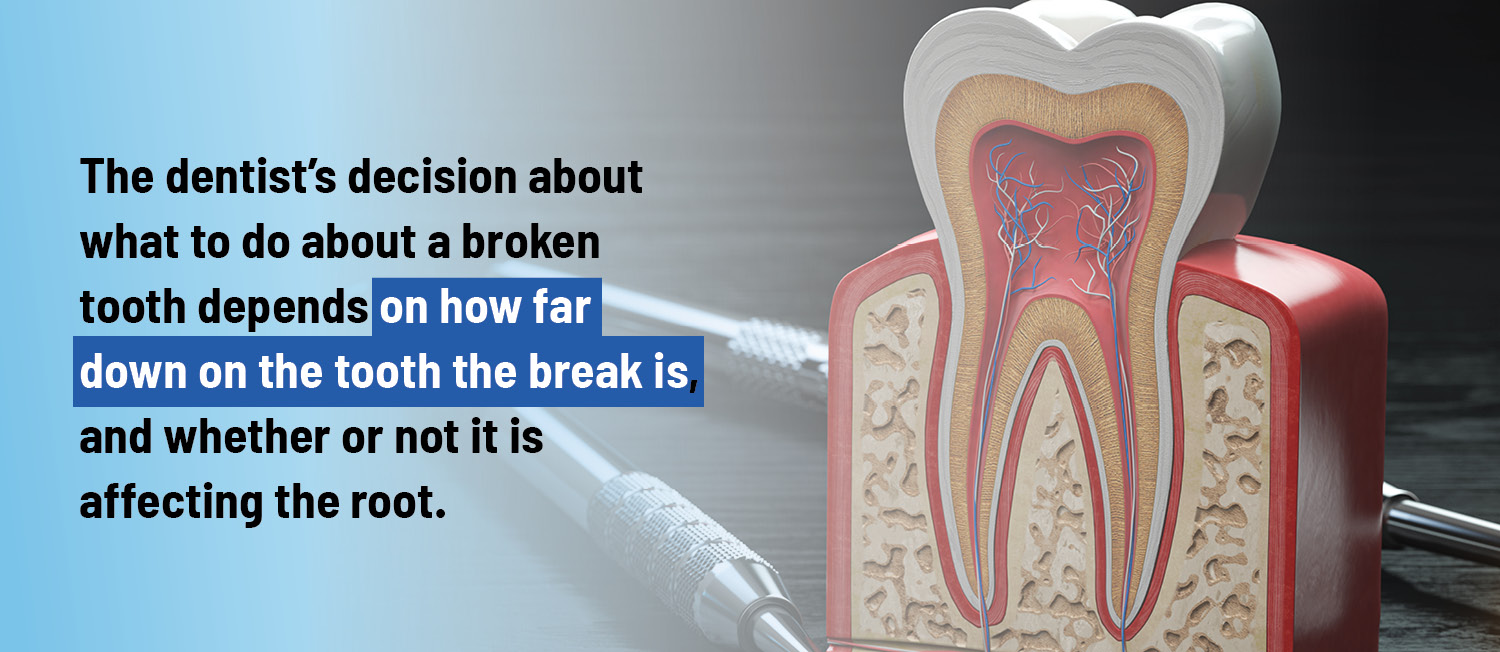 The dentist’s decision about what to do about a broken
tooth depends on how far
down on the tooth the break is,
and whether or not it is
affecting the root.