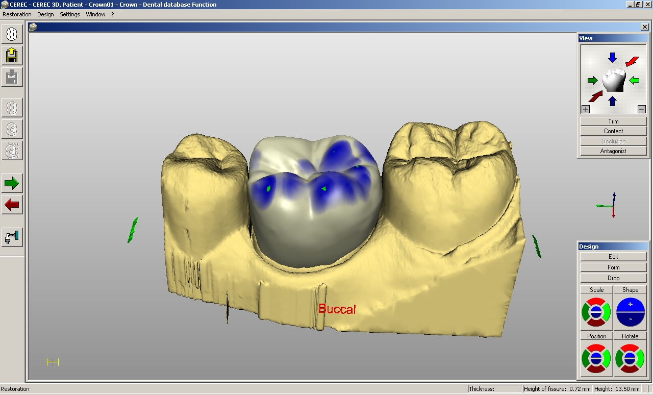 Dental Fillings vs. Crowns: Deciding What You Need