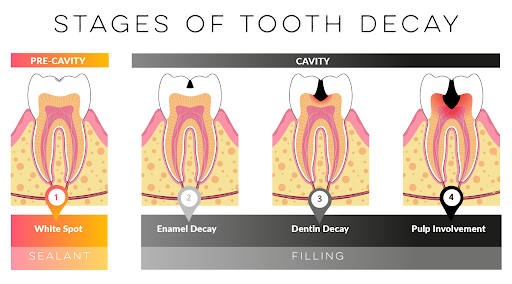 Cavities progress in stages. Pre-cavities appear as white spots on enamel. This "Demineralization" amounts to the tooth enamel beginning to dissolve.